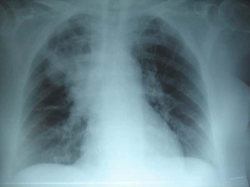 La mucoviscidose n'affecte pas que le système respiratoire. La maladie se caractérise par la production d'un mucus visqueux qui s'écoule mal et obstrue les bronches et les voies digestives. Elle engendre une sensibilité accrue aux infections pulmonaires comme la pneumonie (à l'image). © Joseaperez, Wikipédia, cc by sa 3.0