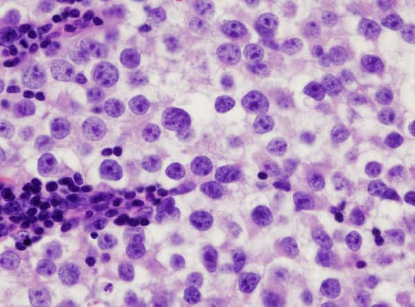 Le cancer du testicule, dont on peut voir des cellules tumorales, se traite bien. En général, son taux de survie se situe entre 90 et 95 %. © KGH, Wikipédia, cc by sa 3.0