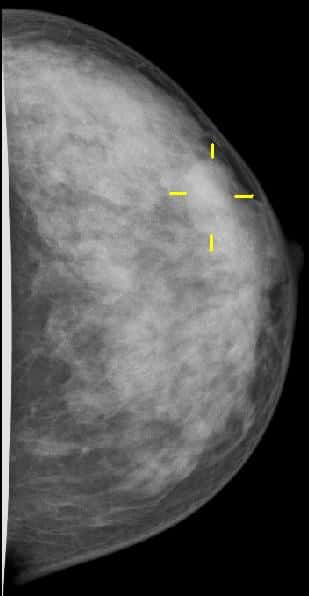 Une mammographie n'est autre qu'une radiographie des seins, réalisée de face et de profil afin d'avoir une vision la plus complète des tissus. Ici, une tumeur est signalée par les traits jaunes. © MBq, Wikipédia, cc by sa 3.0