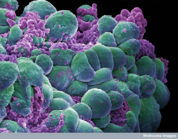 Les cellules cancéreuses du sein (à l'image) vont parfois coloniser d'autres organes, dont les poumons, et former des métastases. Une nouvelle tumeur naît et se développe, aggravant la maladie. © Annie Cavanagh, Wellcome Images, Flickr, cc by nc nd 2.0