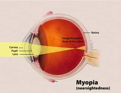 La myopie caractérise une vision qui se trouble à mesure que les objets s'éloignent. Ce schéma illustre la raison de la pathologie. En situation normale et idéale, les rayons lumineux convergent en un point situé au niveau de la rétine (<em>retina)</em>, grâce à la cornée (<em>cornea</em>), la pupille (<em>pupil</em>) et le cristallin (<em>lens</em>). Chez les myopes, ce n'est pas le cas, ils se rencontrent en un point situé avant la rétine, parce que l'œil est trop long. L'image qui arrive sur la rétine est imparfaite, la vision est trouble. © NEI, Wikipédia, DP