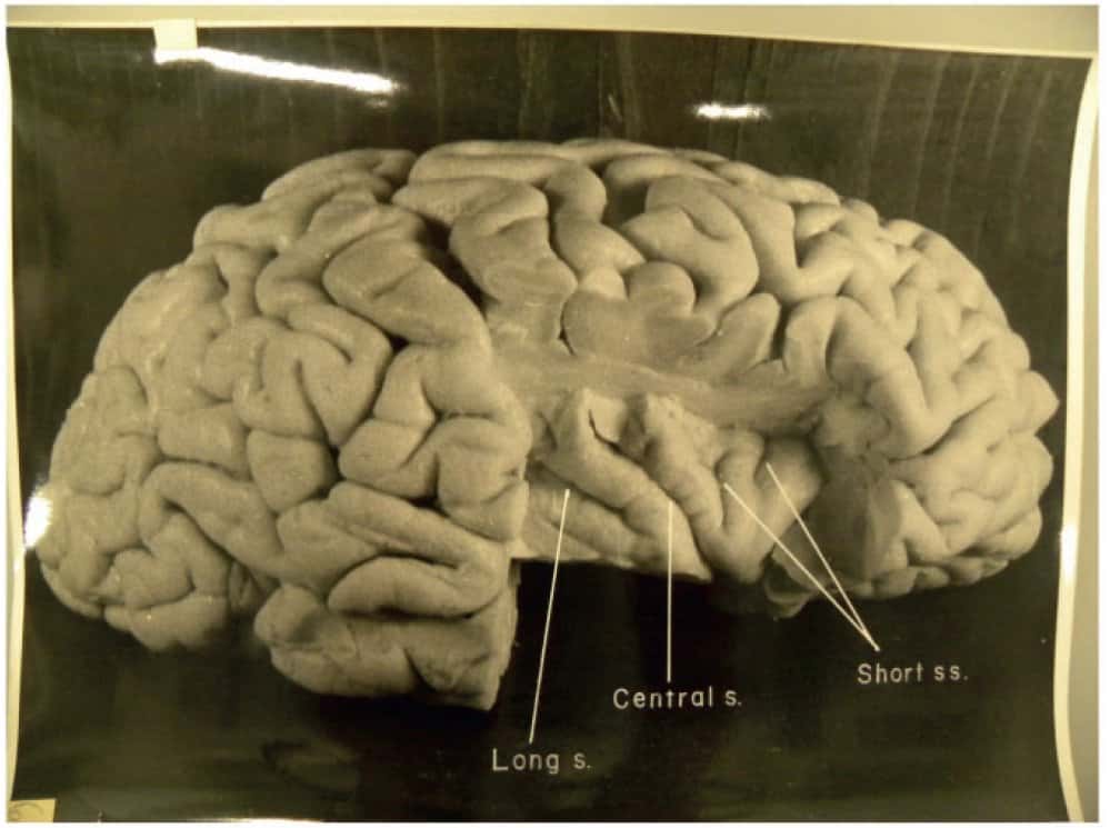 Une des photographies du cerveau d'Albert Einstein prises par Thomas Harvey en 1955. On voit ici l'hémisphère droit montrant l'insula, après la découpe de l'opercule pariétal. Ces images montrent les différents sillons (s sur les légendes – d'époque – incluses dans l'image). © <em>National Museum of Health and Medicine</em>