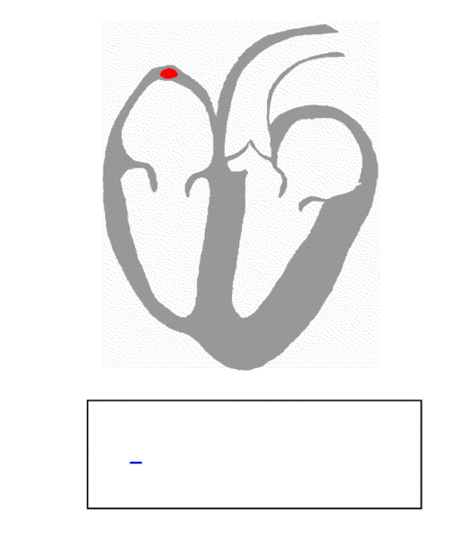 L'impulsion électrique qui permet le battement cardiaque coordonné prend son origine au sommet de l'oreillette droite du cœur (en haut à gauche sur cette animation), au niveau du nœud sinusal. Le signal se répand aux cellules musculaires cardiaques des oreillettes puis se retrouve centralisé au niveau du nœud atrio-ventriculaire, à l'origine de la coordination du mouvement des ventricules. En dessous, le tracé montre les signaux repérés par électrocardiogramme. © Kalumet, Wikipédia, cc by sa 3.0