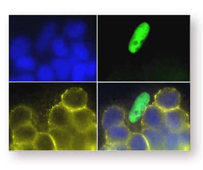 <br />Dans ces cellules, les marquages en bleu, en vert et en jaune correspondent respectivement au noyau, à la protéine EWS/FLI-1 et à la protéine IGFBP-3. Dans les cellules où EWS/FLI-1 est présente (marquage vert), on n'observe pas de protéine IGFBP-3 (absence de marquage jaune), ce qui confirme que la protéine altérée EWS/FLI1 empêche le gène IGFBP-3 de s'exprimer. &copy; A. Prieur/Institut Curie