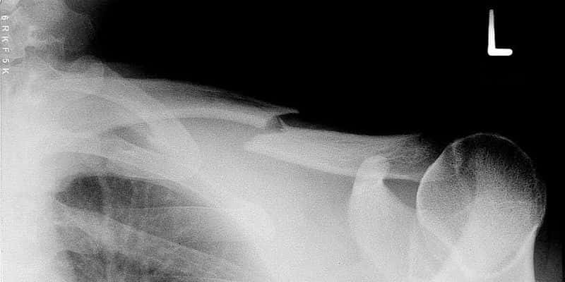 Cette image montre une double fracture de la clavicule. L'os, reliant le thorax aux membres supérieurs, est ici cassé en deux endroits, comme le montre cette radiographie. Un peu de plastique pour réparer ça ? © Erik Streb, Wikipédia, cc by sa 3.0