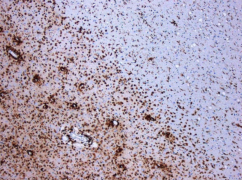 La sclérose en plaques est une maladie auto-immune inflammatoire, qui se caractérise par la perte de la gaine de myéline autour des axones des neurones, une structure permettant d'accélérer l'influx nerveux. À l'image, on peut voir en marron les macrophages attaquer le tissu nerveux. © Marvin101, Wikipédia, cc by sa 3.0