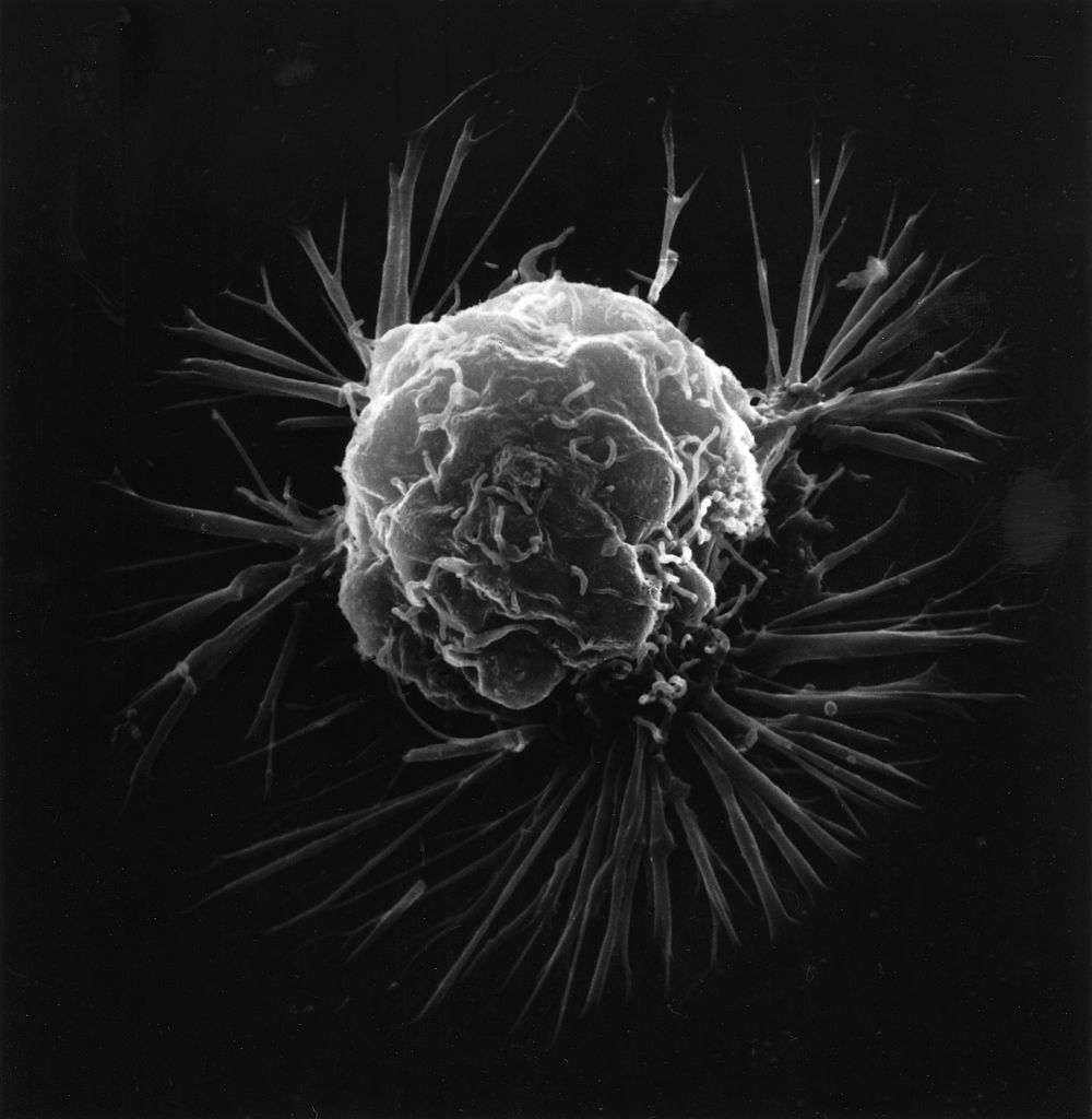Image de microscopie électronique d'une cellule cancéreuse. Quand ces cellules ne cessent de se multiplier, ceci aboutit à la formation d'une tumeur. © <em>National Cancer Institute</em>, Wikimedia Commons, cc by sa 3.0