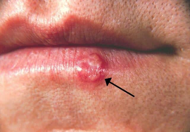 Il existe deux types de virus herpès simplex : le HSV-1 principalement responsable des herpès oraux faciaux, et le HSV-2 qui provoque majoritairement de l'herpès génital. © BernardBill5, Wikimedia Commons, cc by sa 3.0