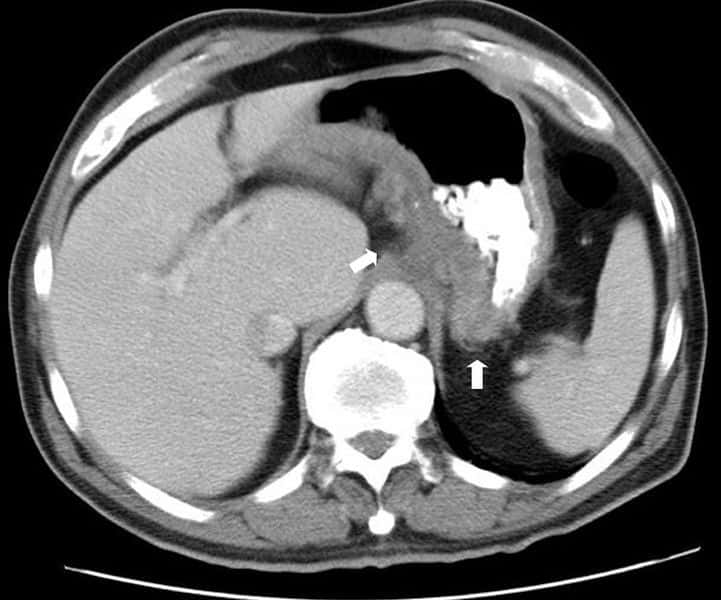 Scanner de l'estomac d'un patient atteint de la maladie de Crohn, une maladie inflammatoire chronique intestinale de nature auto-immune. © Samir, Wikimedia Commons, cc by sa 3.0