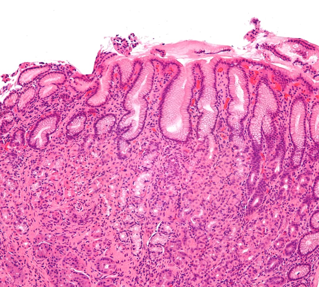 Photomicrographie d’une gastrite due à <em>Helicobacter pylori</em>. On considère que la moitié de la population mondiale porte cet agent infectieux. © Nephron, Wikimedia Commons, cc by sa 3.0