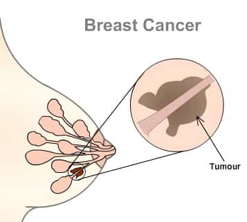Le cancer du sein correspond à une tumeur (<em>tumour</em>) maligne de la glande mammaire. Après une grossesse, l'expression génétique des cellules mammaires change. © TipsTimes, Flickr, cc by sa 2.0