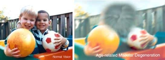 La DMLA affecte profondément l'acuité visuelle. Ces deux images représentent une même scène perçue avec une vision normale (à gauche) ou chez une personne atteinte de DMLA. © NIH