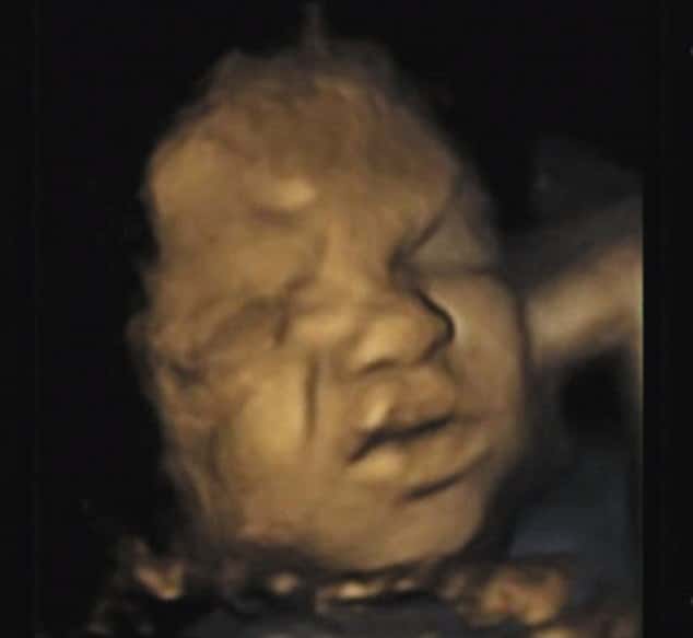 Image d'échographie 3D à 24 semaines de grossesse. La lèvre du fœtus semble se retrousser un peu mais l'expression du visage change peu. © Université de Durham