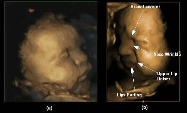 Images d’échographie 3D à 32 semaines de grossesse. (a) visage neutre non expressif ; (b) visage exprimant la douleur. Plusieurs mouvements interviennent : abaissement des sourcils, froncement du nez, soulèvement de la lèvre supérieure et ouverture de la bouche. © Université de Durham