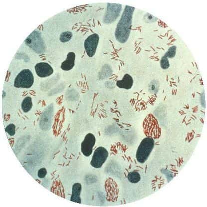 <em>Mycobacterium leprae</em>, ici visible à partir d'un échantillon de la peau d'un lépreux, n'aurait que peu évolué durant le dernier millénaire. Pourtant, à une époque où la lèpre restait incurable, le nombre de cas a diminué en Europe. Probablement parce que les habitants ont commencé à se montrer insensibles à l'infection. Pour une fois que ce ne sont pas les bactéries qui deviennent résistantes... © CDC