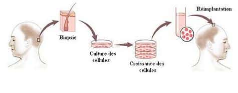 Les différentes étapes du clonage capillaire <br />(Crédit : Intercytex/Christophe Olry/Futura-Sciences)
