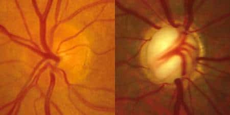 Papille optique, normale à gauche, glaucomeuse à droite. Crédit <em>Belgian Glaucoma Society</em>