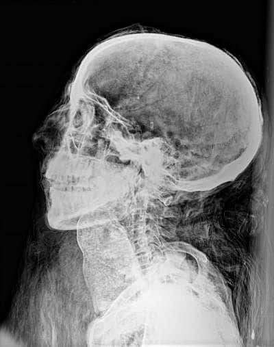 Radiographie de la tête d’une Egyptienne enceinte qui révèle une érosion anormale des lobes pariétaux pouvant indiquer la présence de parasites morts, d’anémie sévère ou de malnutrition. © <em>The Field Museum</em>.