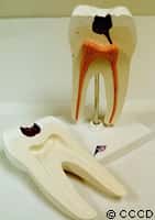 Une carie dentaire est une déminéralisation locale due à l'activité de bactéries. © CCCD