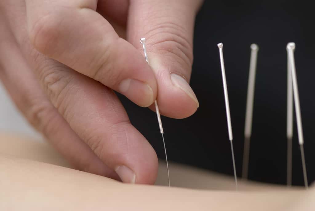 L’acupuncture semble plus efficace que l’absence de traitement. © Max Tactic, Fotolia
