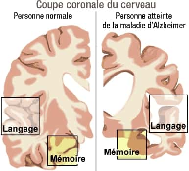 Les zones du cerveau détruites par la maladie d'Alzheimer sont en charge du langage et de la mémoire. © Domaine public