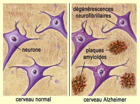 Ce sont les plaques amyloïdes et les dégénérescences neurofibrillaires liées aux protéines Tau qui dégradent les neurones du cerveau des personnes malades. © Université de McGill