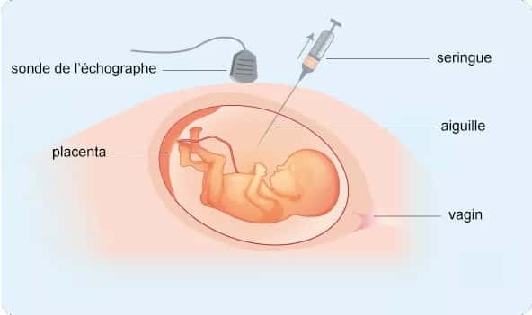 La sonde de l'échographie permet de guider le geste du gynécologue-obstétricien lorsqu'il introduit l'aiguille dans la poche amniotique lors de l'amniocenthèse. © Ameli 