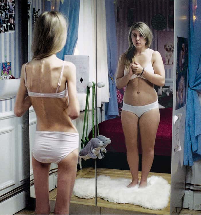 L'anorexie mentale est une maladie qui frappe souvent les femmes, à partir de l'adolescence. L'image que la patiente a d’elle-même est déformée, et ne reflète pas la réalité. © KairosOfTyre, Flickr, by nc sa 2.0
