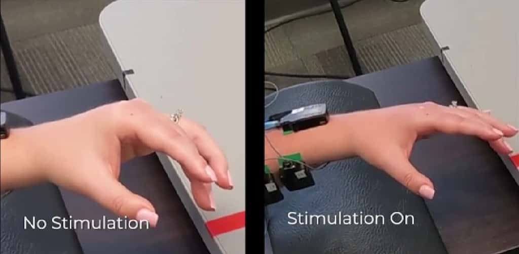 En utilisant la stimulation électrique de la moelle épinière, des chercheurs aident à restaurer les mouvements des bras et des mains chez des patients ayant survécu à des accidents vasculaires cérébraux. © Powell, M.P., Verma, N., Sorensen, E. <em>et al. Nat Med</em> (2023)