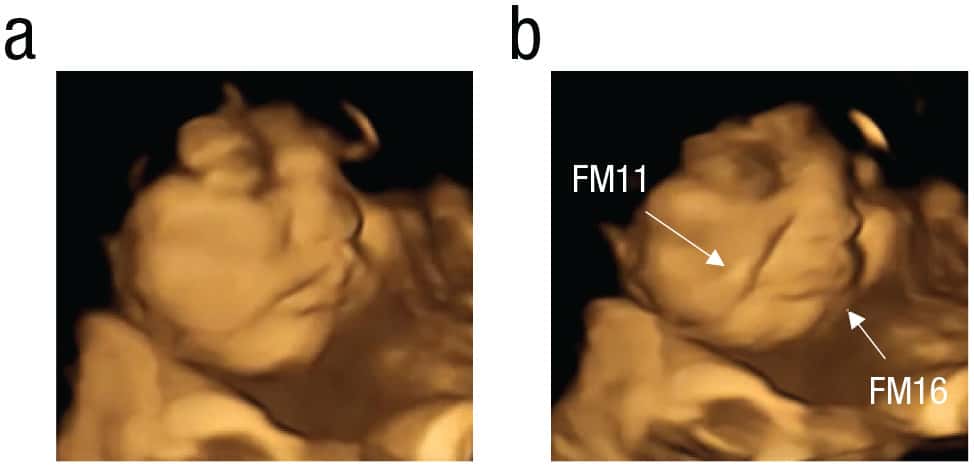 Pas content ! Exemple de visage d'un fœtus exposé au chou : (a) visage neutre, (b) visage mécontent. © Beyza Ustun, Université de Durham, Département de psychologie, Psychological Science, CC by-nc 4.0