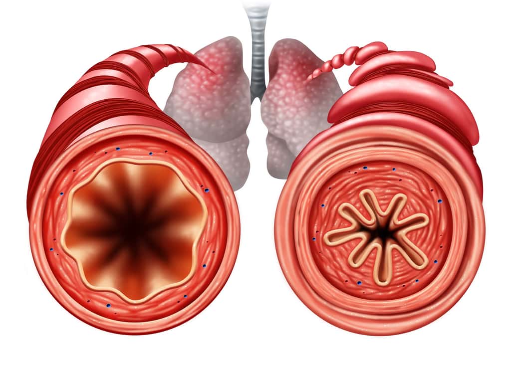 Chez les asthmatiques, il faut améliorer la dilatation des voies respiratoires pour aider l’air à mieux circuler. © freshidea, Fotolia
