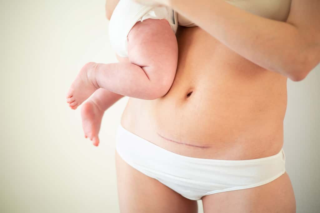 Environ 20 % des bébés naissent par césarienne en France. © Анна Брусницына, Adobe Stock
