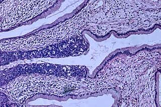 Cancer du col de l'utérus faisant suite à une lésion précancéreuse (dysplasie)© Haymanj, Public domain, via Wikimedia Commons