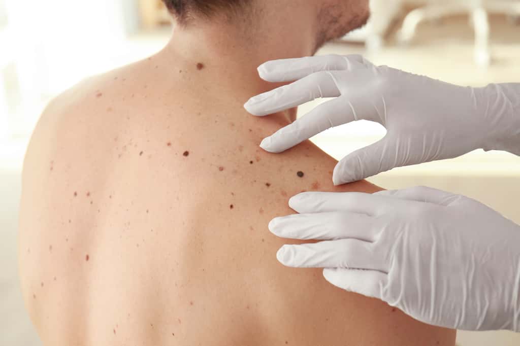  Un vaccin à ARN messager est actuellement en phase de test pour soigner le cancer de la peau. © Africa Studio, Adobe Stock