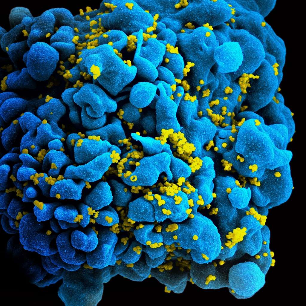 Un lymphocyte T infecté par le VIH observé en microscopie électronique. La mutation CCR5Δ32 empêche l’entrée du virus dans la cellule. © NIAID, Flickr, CC by 2.0