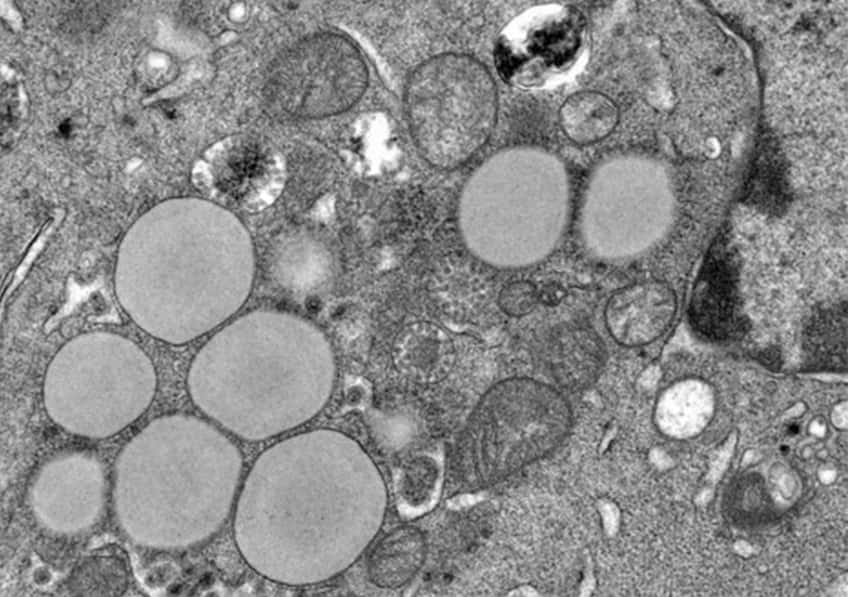 Les cellules infectées par le virus de l’hépatite C accumulent de grosses gouttelettes lipidiques, un phénomène appelé stéatose qui contribue au développement d’une fibrose du foie chez les patients atteints d’hépatite chronique C. ©  P. Roingeard, Inserm