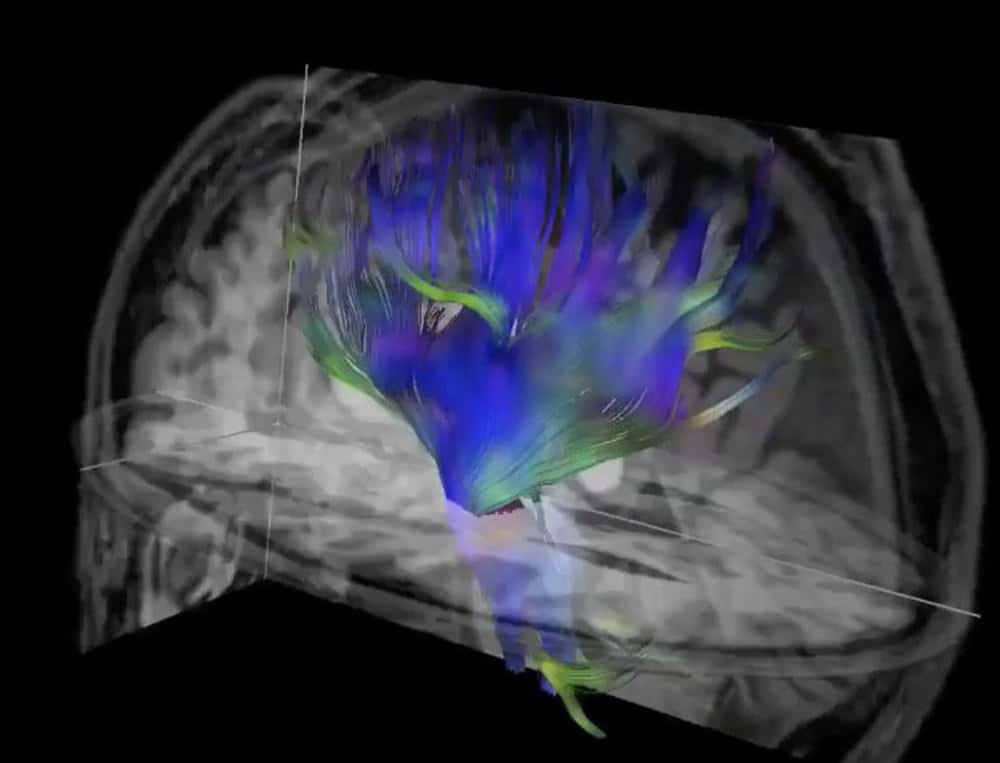 Imagerie du tenseur de diffusion, une technique d'IRM du cerveau. © RSNA, Michael L. Lipton