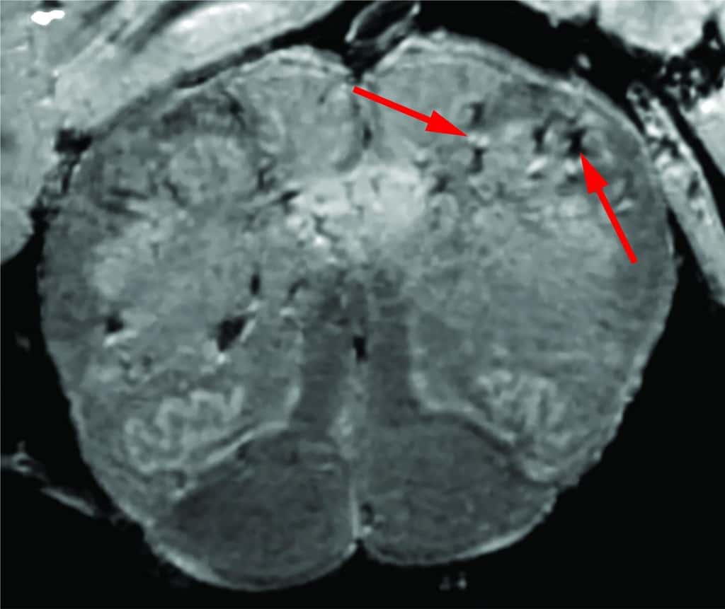 L'IRM à haute résolution du tronc cérébral d'un patient décédé du Covid-19. La flèche rouge de gauche montre une zone d'hyper-intensité (tache claire) et l'autre flèche, une zone d'hypo-intensité (tache sombre). © NIH, NINDS