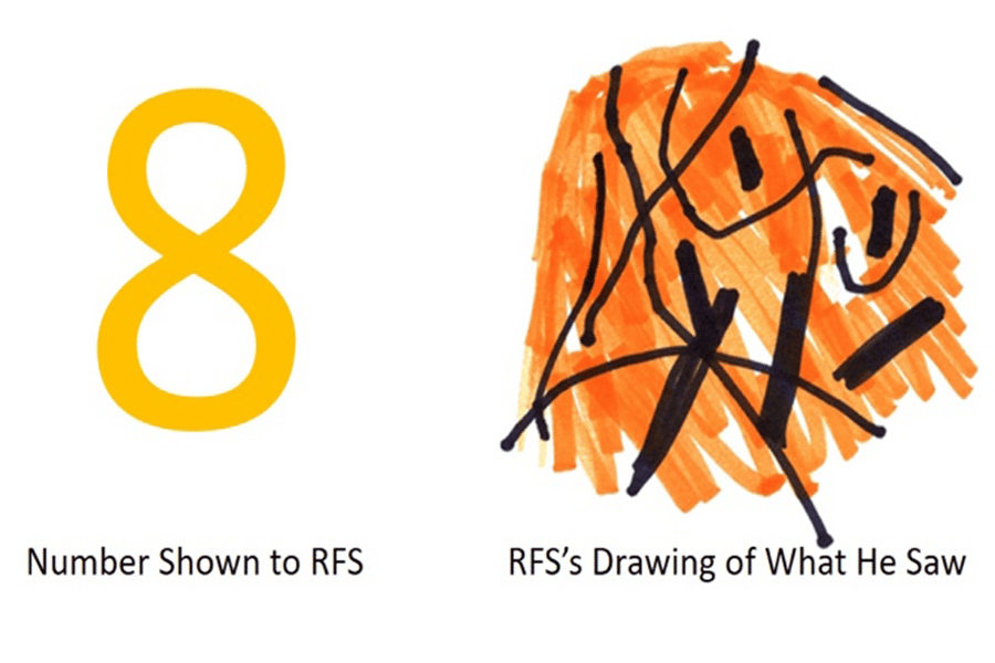 À gauche, le chiffre présenté au patient, à droite ce que le patient a dessiné en prenant le chiffre pour modèle. © <em>Johns Hopkins University</em>