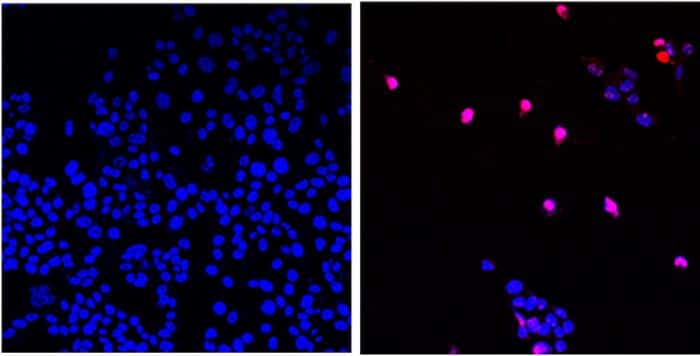 La molécule AOH1996 cible une variante cancéreuse de la protéine ANCP. Dans sa forme mutée, cette protéine est essentielle à la réplication et à la réparation de l'ADN dans toutes les tumeurs en expansion. On voit ici des cellules cancéreuses non traitées (à gauche) et des cellules cancéreuses traitées avec AOH1996 (à droite) qui subissent une mort cellulaire programmée (en violet). © City of hope