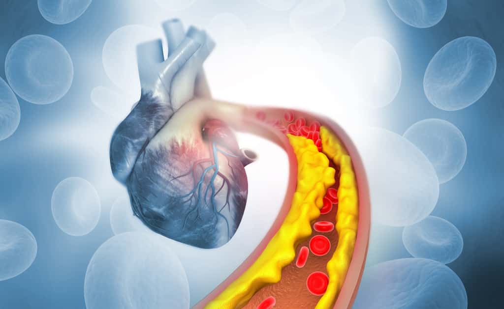 Le cholestérol a un effet délétère sur les artères et peut conduire aux maladies cardiovasculaires ou l'accident vasculaire cérébral. © Rasi, Adobe Stock