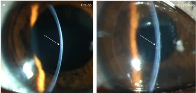 Photographies avant l’opération (à gauche) et un jour après l’opération (à droite), les flèches indiquent un changement immédiat d’épaisseur et de courbure dans la cornée centrale. © M. Rafat et al., 2022