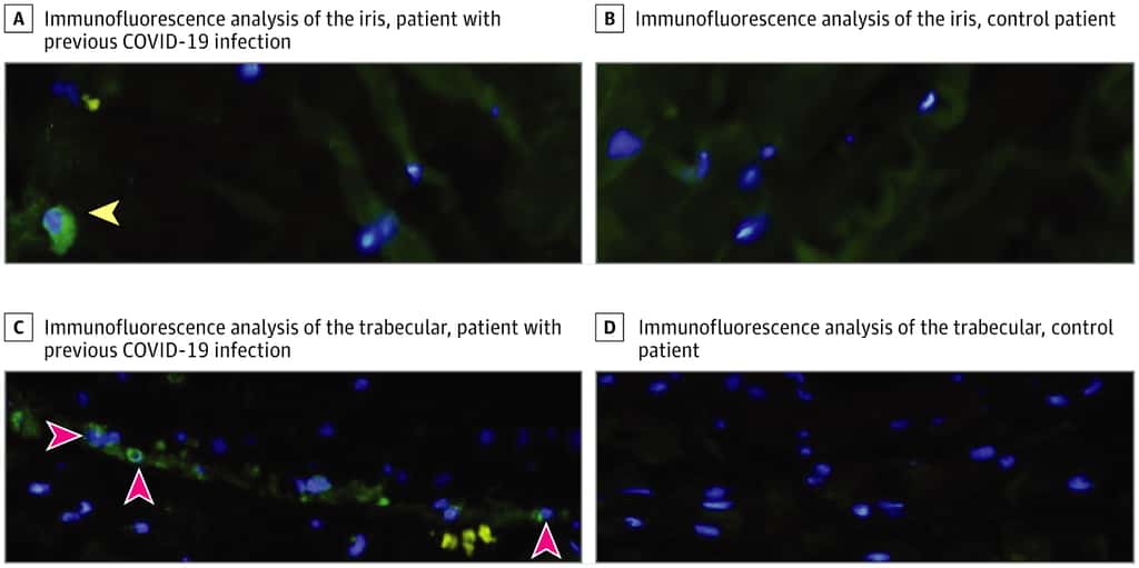 Résultats de l'immunofluorescence dans l'iris et le trabéculum de la patiente guérie de la Covid-19. La fluorescence verte est spécifique de la nucléocapside du SARS-CoV-2. Ces échantillons sont comparés à ceux d'un patient ayant aussi eu un glaucome mais non infecté par le coronavirus. La fluorescence verte spécifique de la nucléocapside est absente. © Ying Yan et al., <em>Jama Ophtalmology</em>