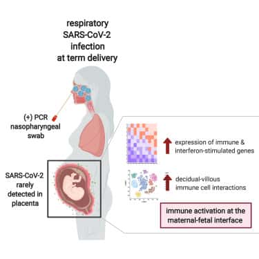 Les femmes enceintes positives au SARS-CoV-2 présentent une inflammation robuste au niveau du placenta avec l'activation des cellules immunitaires et des gènes stimulés par les interférons. © Alice Lu-Culligan et <em>al. Med, Cell Press</em>