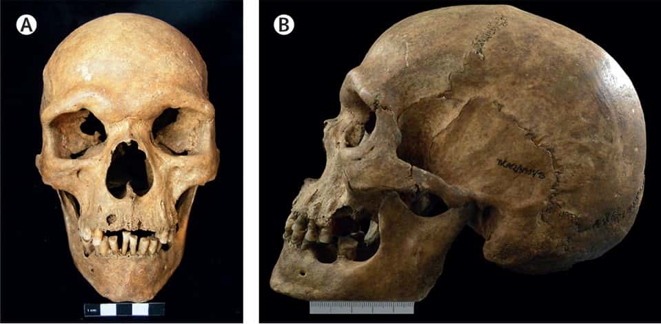 Voici, vieux de 1.000 ans, le crâne de l'individu porteur de la maladie de Klinefelter. © Xavier Roca-Rada et <em>al. The Lancet</em>