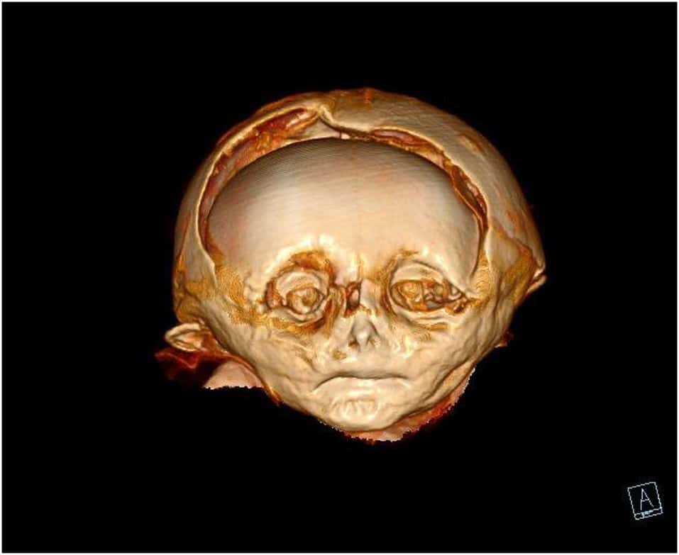 Déformation des os du crâne visible à l'imagerie non invasive. © Revue <em>Frontiers</em> 