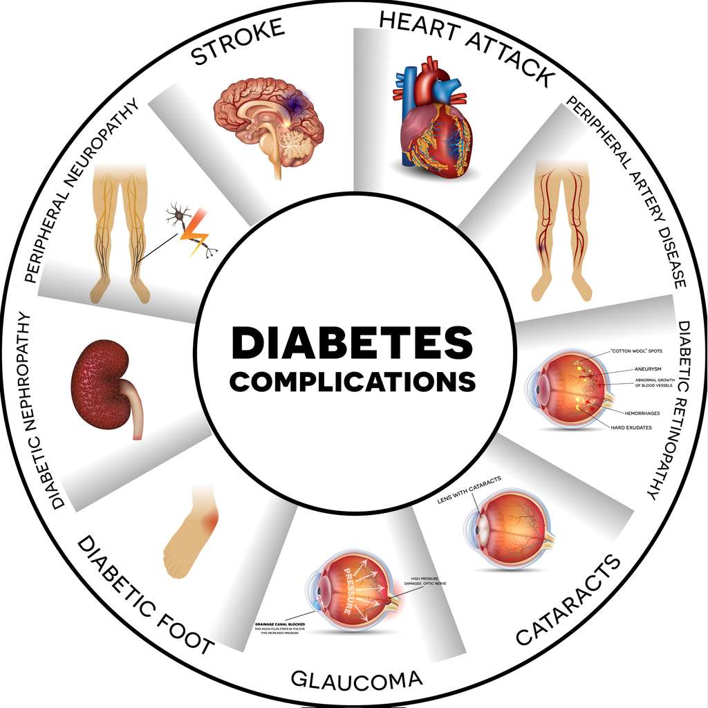 Les différentes complications du diabète. © CC Reineg, Adobe Stock