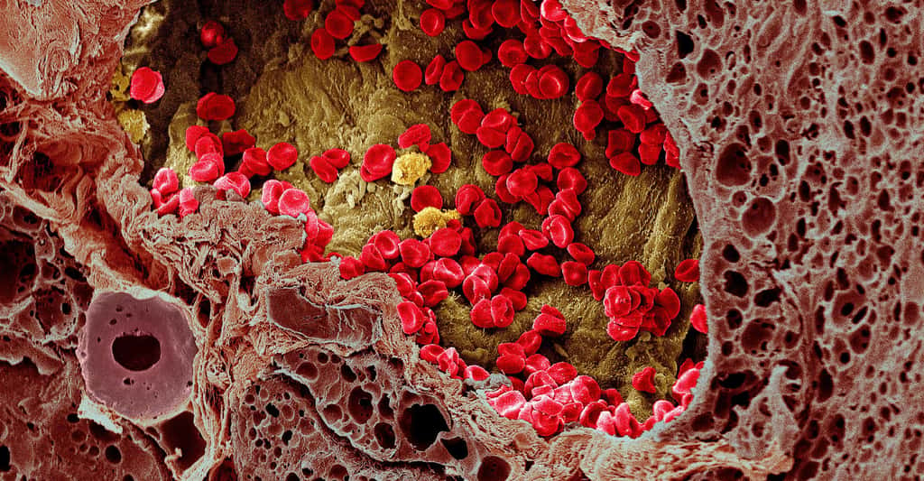 Un vaisseau sanguin dans un mélanome