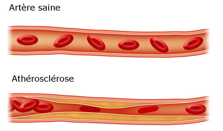 L’accumulation de chlolestérol et de triglycérides dans le sang peut conduire à l’athérosclérose. L’athérosclérose se caractérise par le dépôt d’une plaque de lipides sur la paroi des artères. Elle est à l’origine de nombreux problèmes cardiovasculaires. © Adapté de Icewalker cs, Wikimedia Commons, cc by sa 3.0