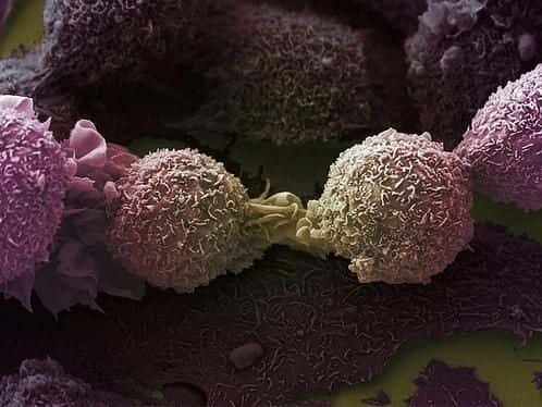 Des cellules du cancer de poumons, ici vues en microscopie électronique à balayage. Chez la souris les antioxydants ne limitent pas la progression de leur croissance mais au contraire la stimule. © Wellcome Images, Flickr, cc by nc nd 2.0